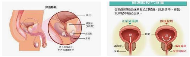 202106091623208602122030.png 攝護腺癌的治療